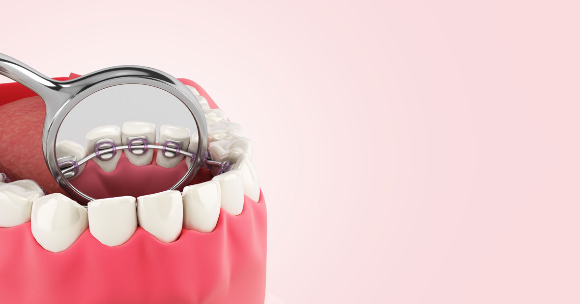 orthodontie linguale