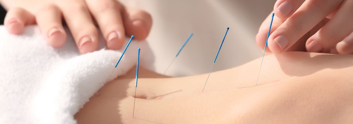 Acupuncture