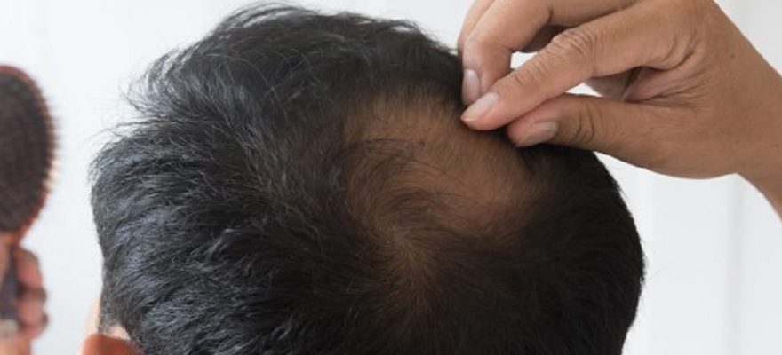 Comment lutter efficacement contre la chute de cheveux chez l’homme ?