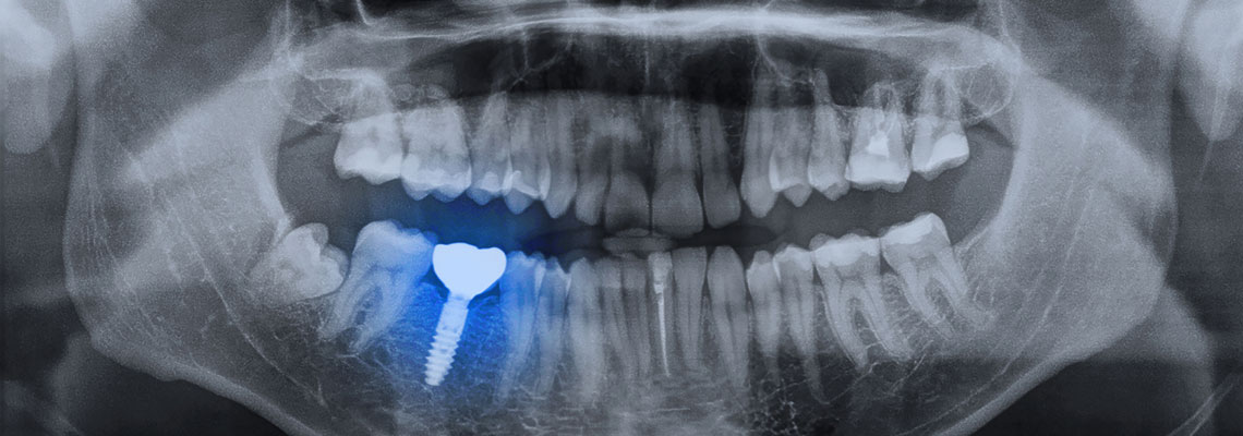 Implant basal