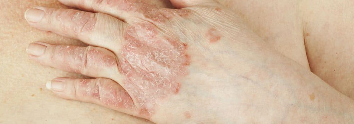 psoriasis des mains